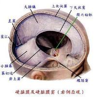 新生兒顱內出血