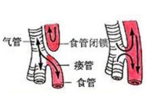 食管氣管瘺 食管氣管瘺