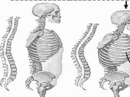 維生素D依賴性佝僂病