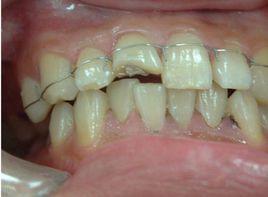 松牙固定術 松牙固定術