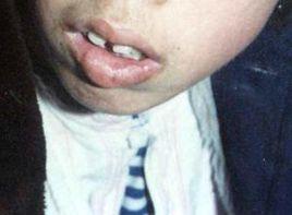 下唇腫脹外翻 下唇腫脹外翻