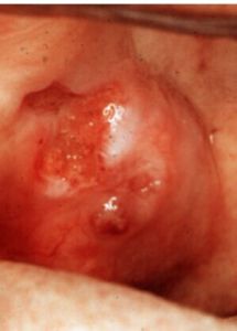 腺樣囊性癌 腺樣囊性癌