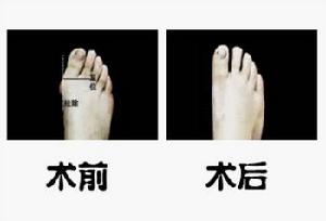 微孔精雕顯微術