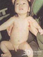 眼腦腎綜合徵 眼腦腎綜合徵