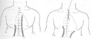 原發性縱隔感染