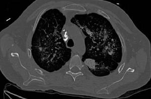肺纖維灶 肺纖維灶