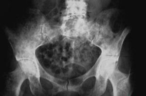 骨質溶解 骨質溶解