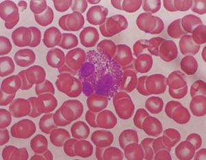 嗜酸粒細胞性胃腸炎 嗜酸粒細胞性胃腸炎