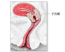 （圖）子宮頸平滑肌瘤
