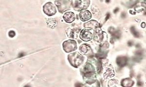 腎上皮細胞管型