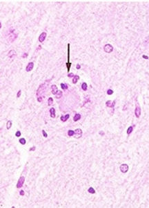 噬神經細胞現象 噬神經細胞現象