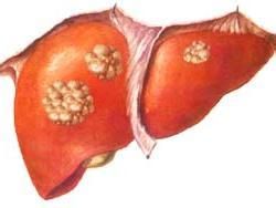 轉移性肝癌