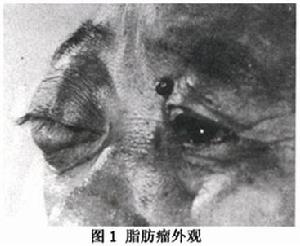 眼眶脂肪瘤 眼眶脂肪瘤