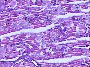 嫌色細胞癌 嫌色細胞癌