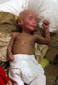 萎縮嬰兒 萎縮嬰兒