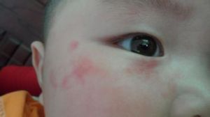 寶寶毛細血管瘤