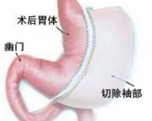 縮胃手術 縮胃手術