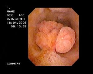 膽囊膽固醇沉著症