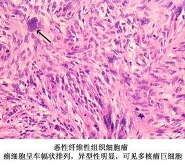 骨惡化纖維組織細胞瘤 骨惡化纖維組織細胞瘤