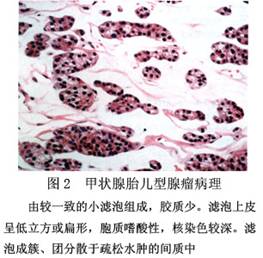 (圖)甲狀腺腺瘤