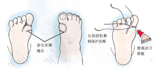 先天性拇趾內翻