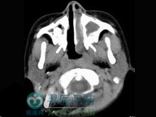 原發性鼻腔淋巴瘤