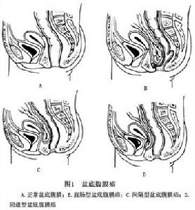 盆底腹膜疝 圖1