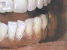 急性頜骨骨髓炎