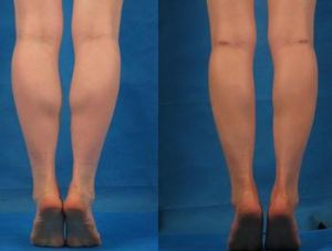 神經阻斷瘦小腿術