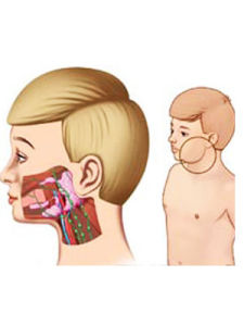 流行性腮腺炎 流行性腮腺炎