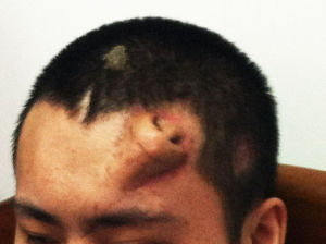 鼻預構術 鼻預構術