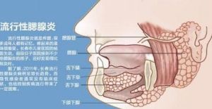 流行性腮腺炎中醫療法 流行性腮腺炎中醫療法