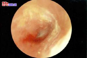 急性化膿性中耳炎