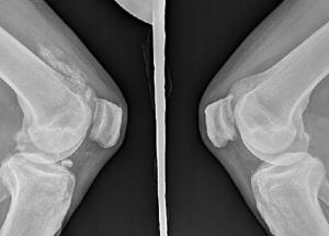 滑膜骨軟骨瘤 滑膜骨軟骨瘤