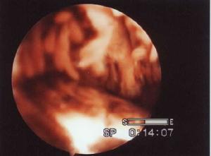 膝關節創傷性滑膜炎及關節血腫 膝關節創傷性滑膜炎及關節血腫