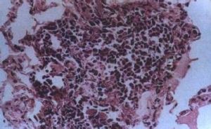 布魯斯氏菌病 布魯斯氏菌病