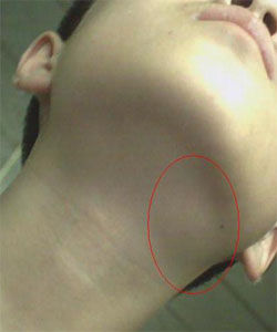 淋巴結髮炎 淋巴結髮炎