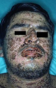 Stevens–Johnson syndrome