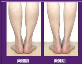 小腿吸脂 小腿吸脂