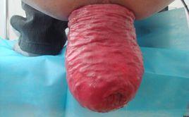 肛門脫出 肛門脫出