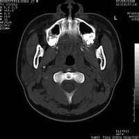顳窩纖維血管瘤