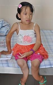 范可尼綜合徵 范可尼綜合徵