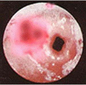 慢性非特異性潰瘍性結腸炎