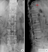 胸椎骨折 胸椎骨折