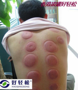 正在拔火罐