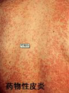 藥物過敏 藥物過敏