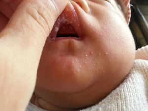 新生兒鵝口瘡