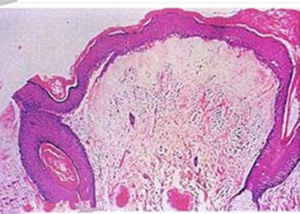 外陰硬化性苔蘚 外陰硬化性苔蘚