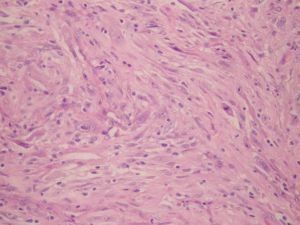 外陰神經鞘瘤 外陰神經鞘瘤