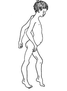 進行性肌營養不良症